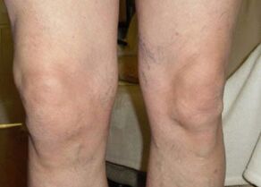 Пред употреба на Osteflex, колената на Нилс беа отечени до крајот на денот.